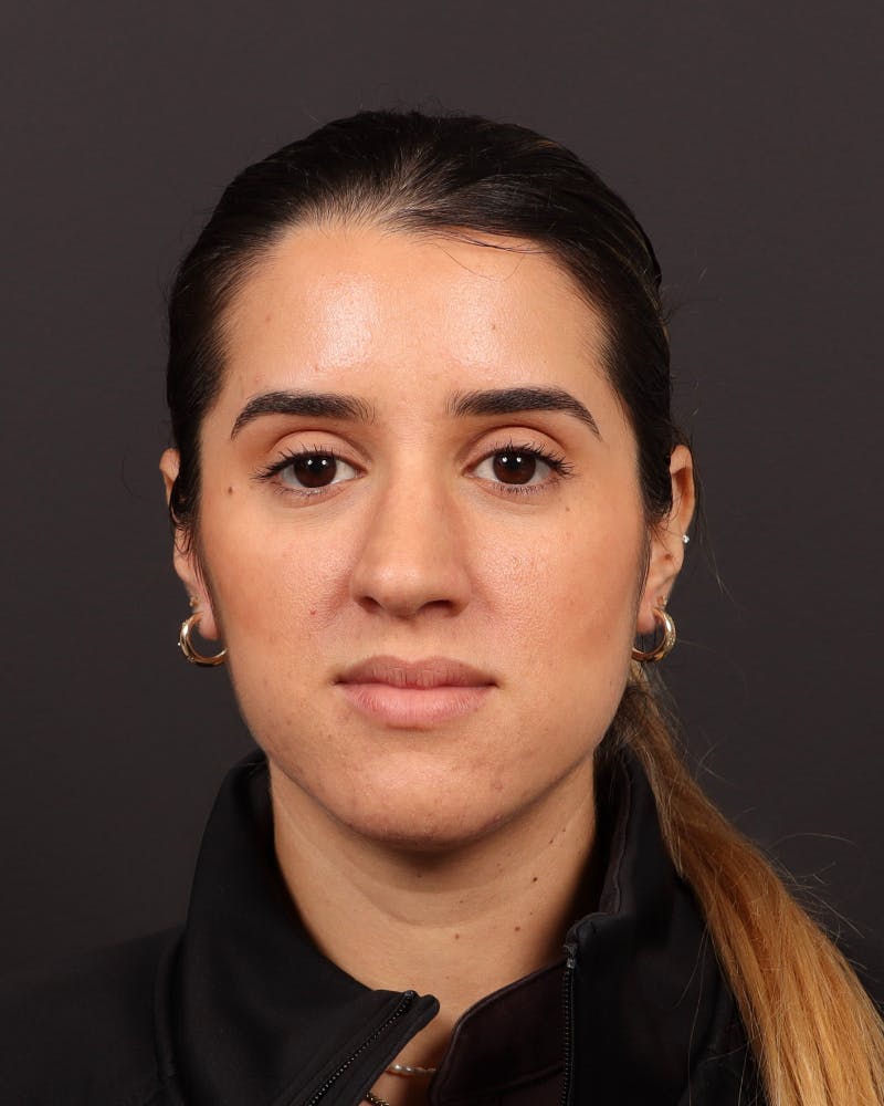 Primary Rhinoplasty Before & After Gallery - Patient 516119 - Image 3