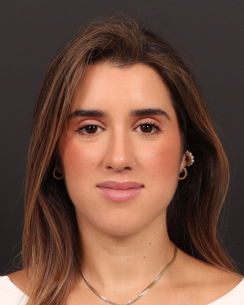 Primary Rhinoplasty Before & After Gallery - Patient 516119 - Image 4