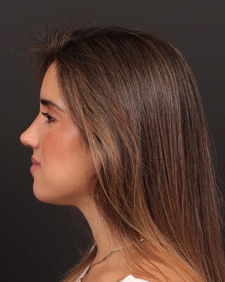 Primary Rhinoplasty Before & After Gallery - Patient 516119 - Image 2