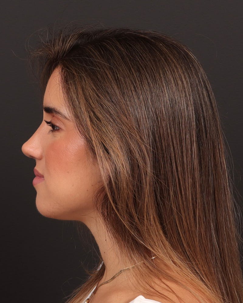 Primary Rhinoplasty Before & After Gallery - Patient 516119 - Image 2