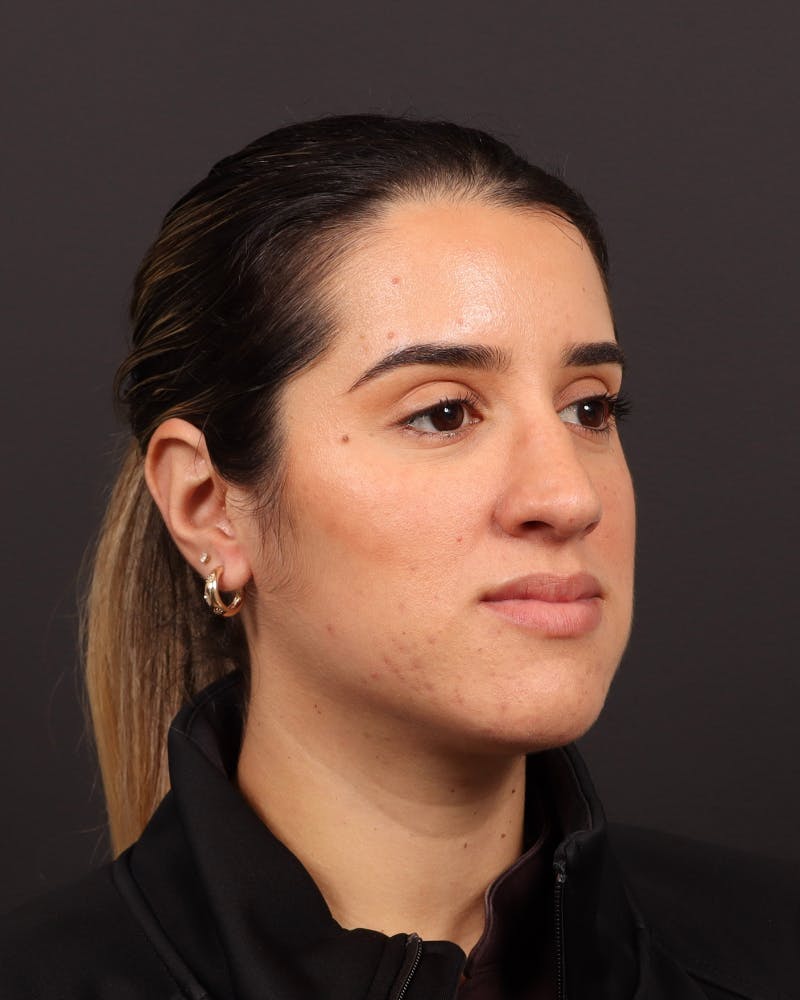 Primary Rhinoplasty Before & After Gallery - Patient 516119 - Image 5