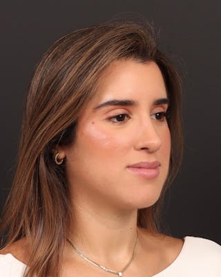 Primary Rhinoplasty Before & After Gallery - Patient 516119 - Image 6