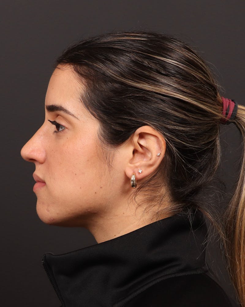 Primary Rhinoplasty Before & After Gallery - Patient 516119 - Image 1