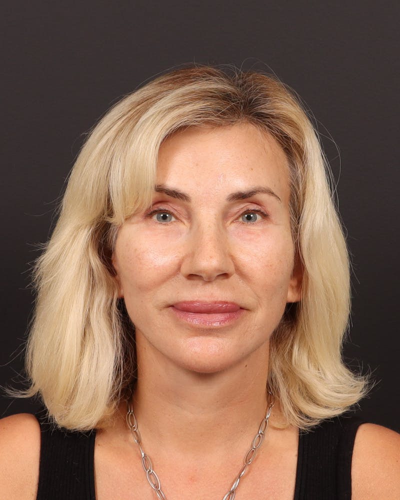Brow Lift  Before & After Gallery - Patient 404065 - Image 2