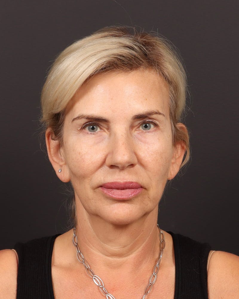 Brow Lift  Before & After Gallery - Patient 404065 - Image 1