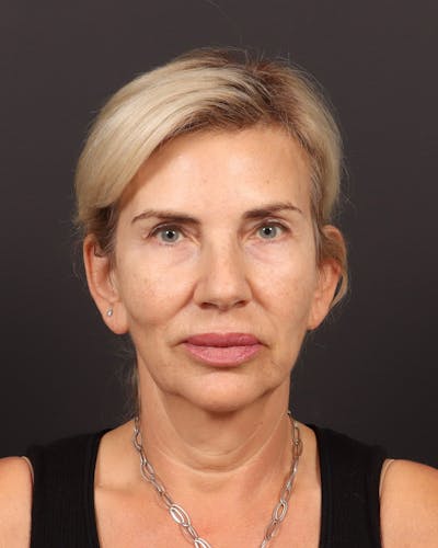Brow Lift Before & After Gallery - Patient 404065 - Image 1