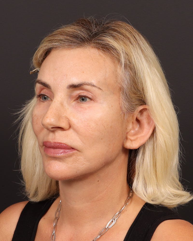Brow Lift  Before & After Gallery - Patient 404065 - Image 4