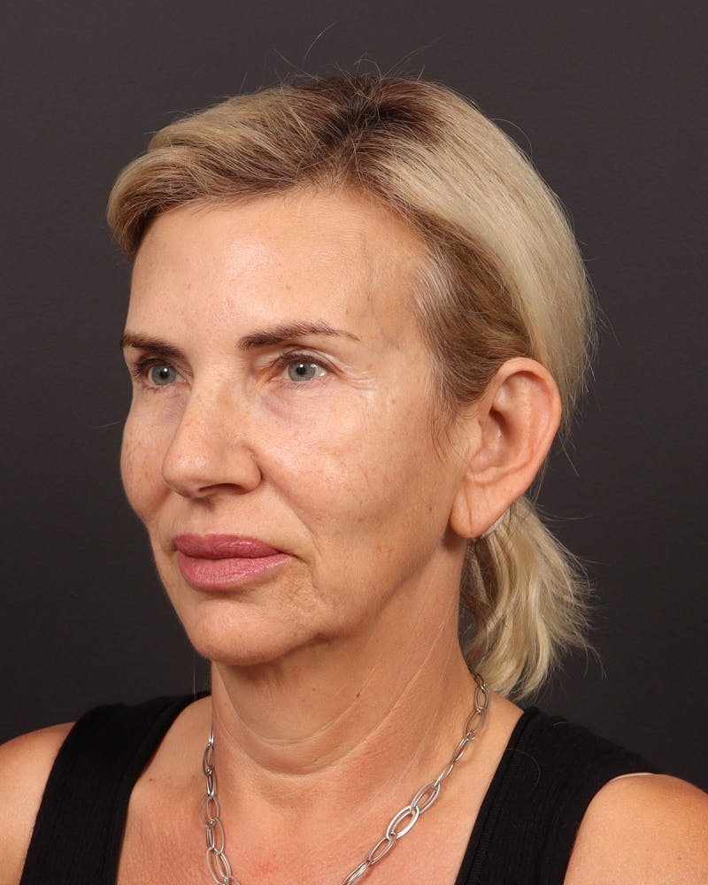 Brow Lift  Before & After Gallery - Patient 404065 - Image 3