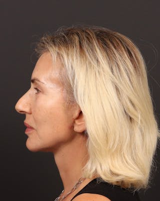 Brow Lift Before & After Gallery - Patient 404065 - Image 6