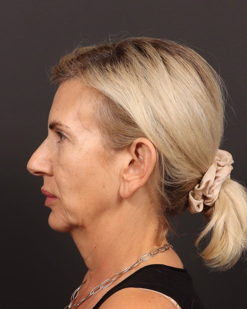 Brow Lift  Before & After Gallery - Patient 404065 - Image 5