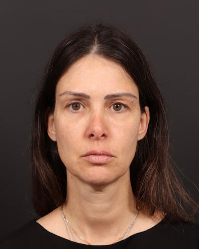Facelift Before & After Gallery - Patient 145093 - Image 1