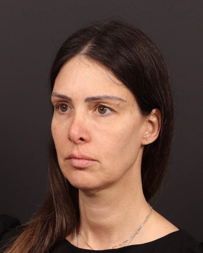 Facelift Before & After Gallery - Patient 145093 - Image 3