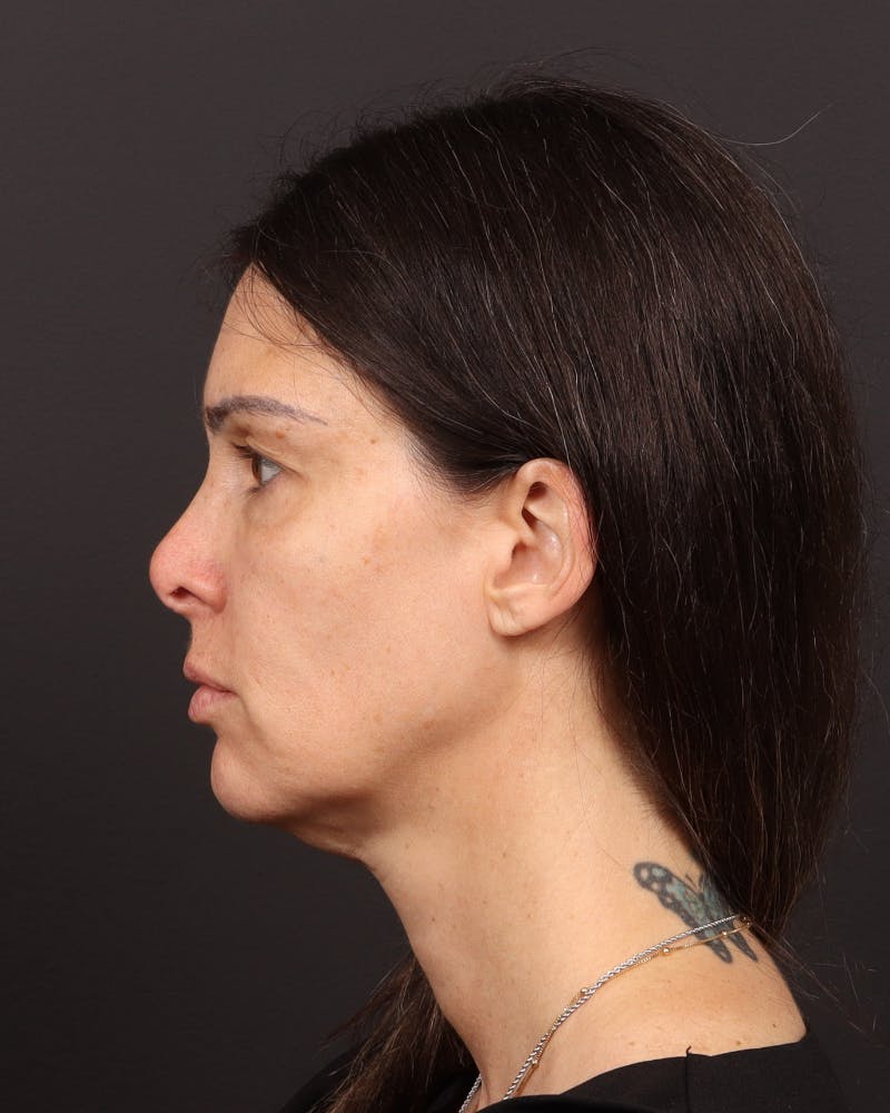 Facelift Before & After Gallery - Patient 145093 - Image 5