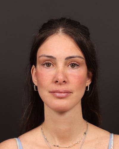 Facelift Before & After Gallery - Patient 145093 - Image 2
