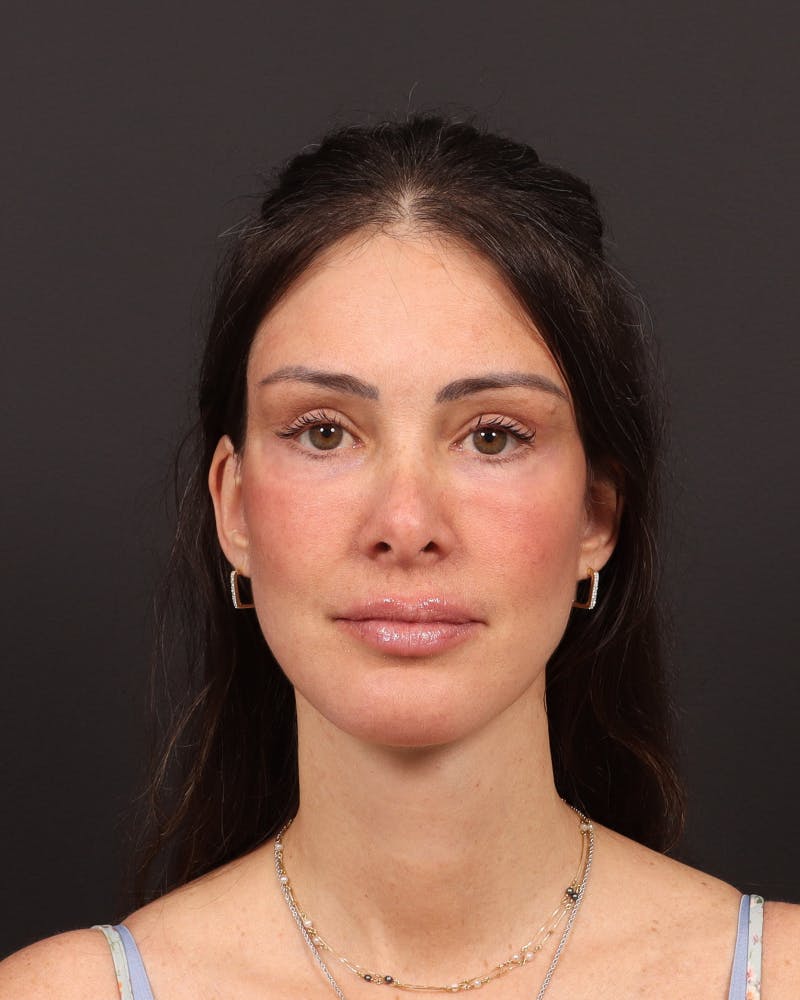 Facelift Before & After Gallery - Patient 145093 - Image 2