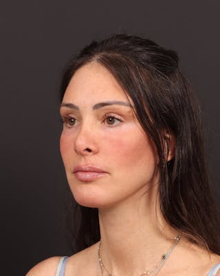 Facelift Before & After Gallery - Patient 145093 - Image 4