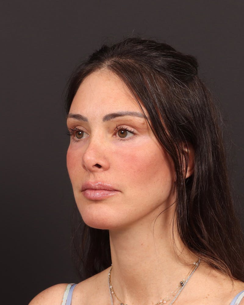 Facelift Before & After Gallery - Patient 145093 - Image 4