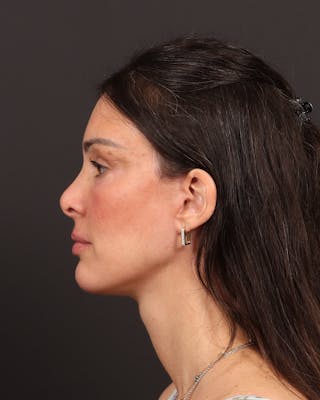 Facelift Before & After Gallery - Patient 145093 - Image 6