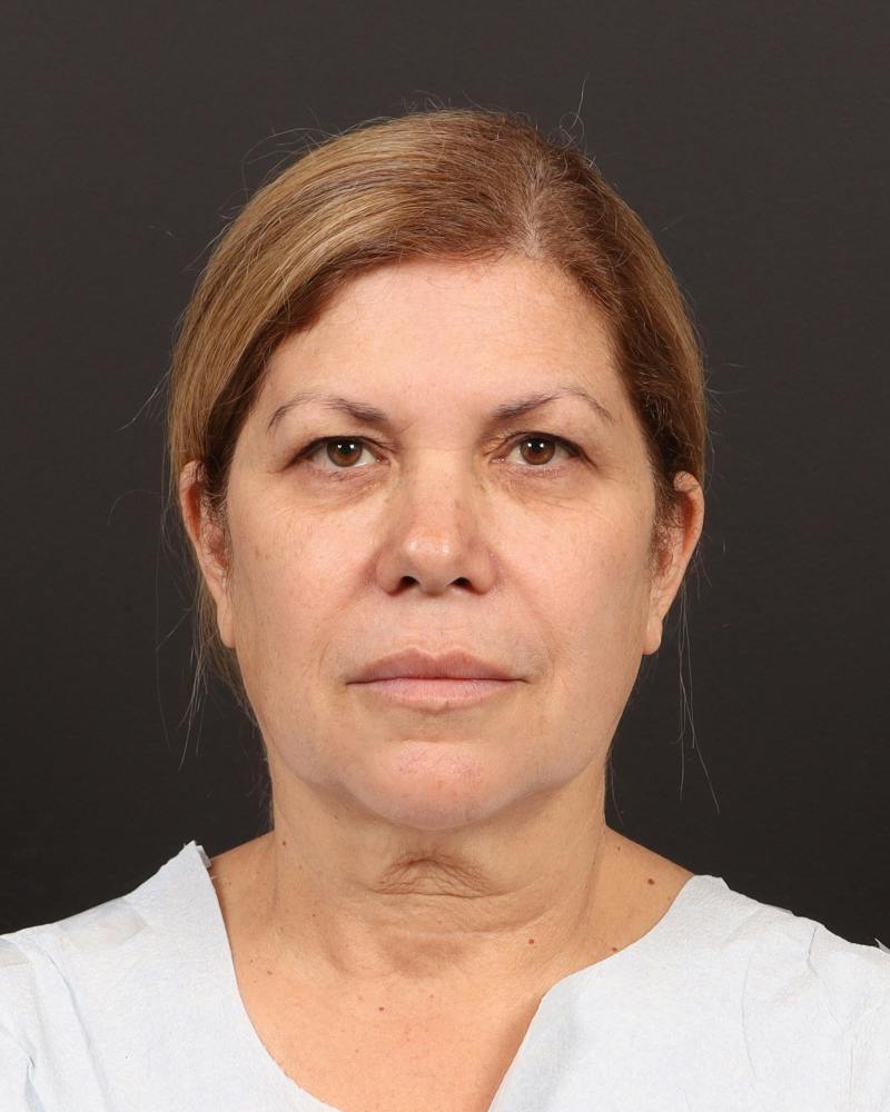 Facelift Before & After Gallery - Patient 133676 - Image 1