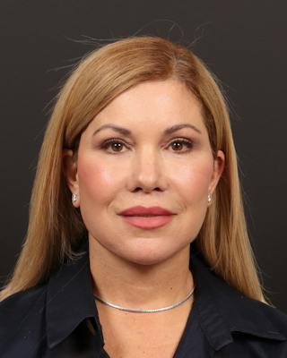 Facelift Before & After Gallery - Patient 133676 - Image 2