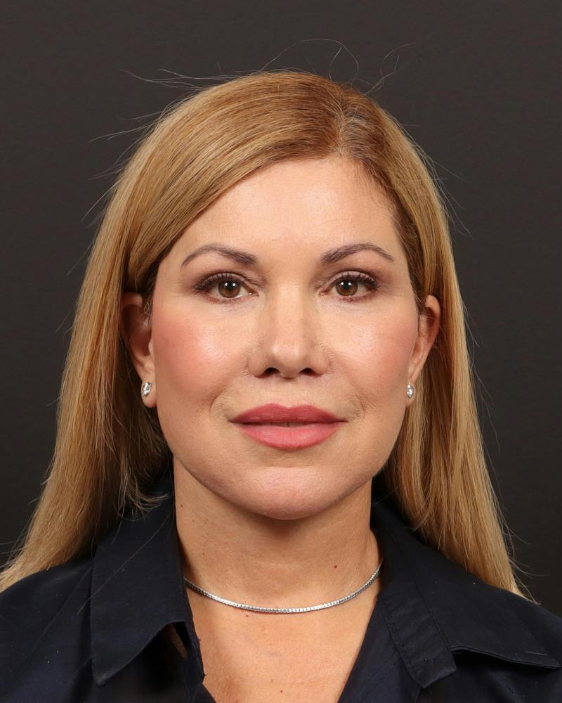 Facelift Before & After Gallery - Patient 133676 - Image 2