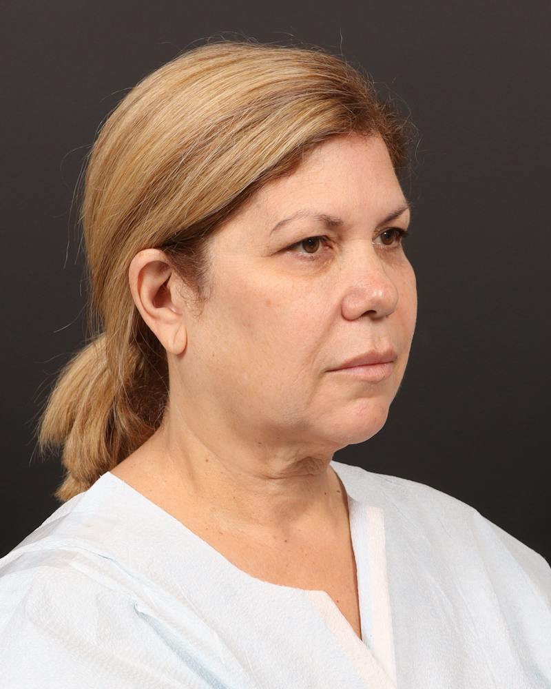 Facelift Before & After Gallery - Patient 133676 - Image 3