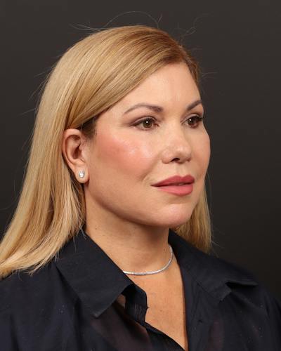 Neck Lift Before & After Gallery - Patient 873169 - Image 2