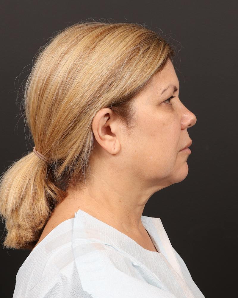 Facelift Before & After Gallery - Patient 133676 - Image 5