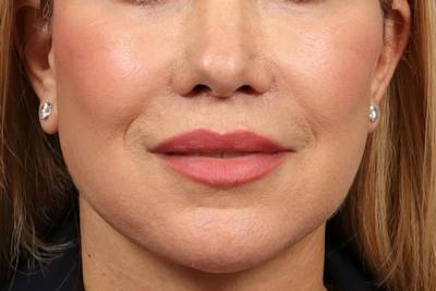 Lip Lift Before & After Gallery - Patient 418814 - Image 1