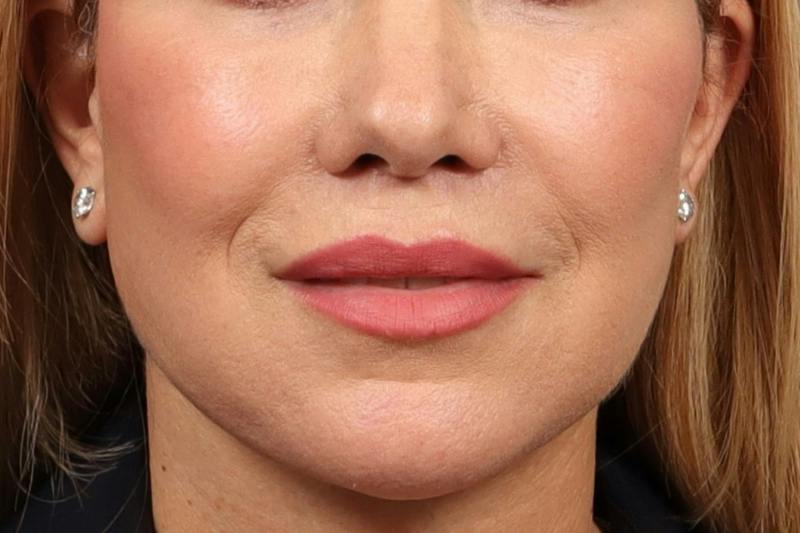 Lip Lift Before & After Gallery - Patient 418814 - Image 1