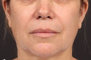 Lip Lift Before & After Gallery - Patient 418814 - Image 2