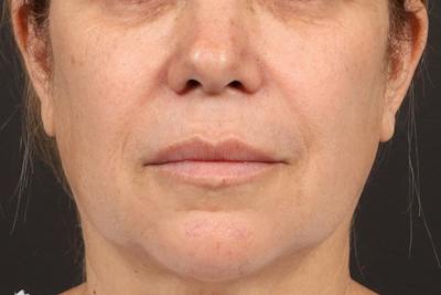 Lip Lift Before & After Gallery - Patient 418814 - Image 2
