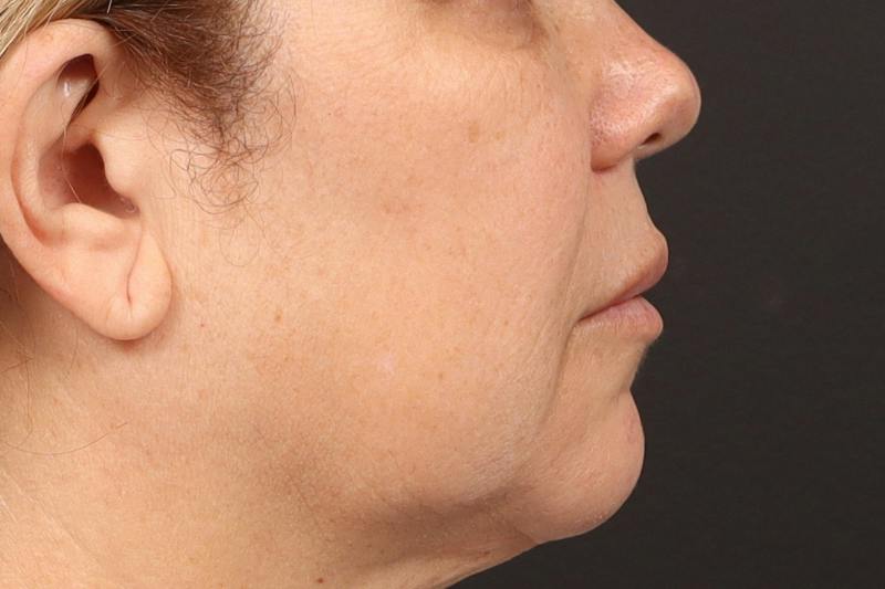 Lip Lift Before & After Gallery - Patient 418814 - Image 3