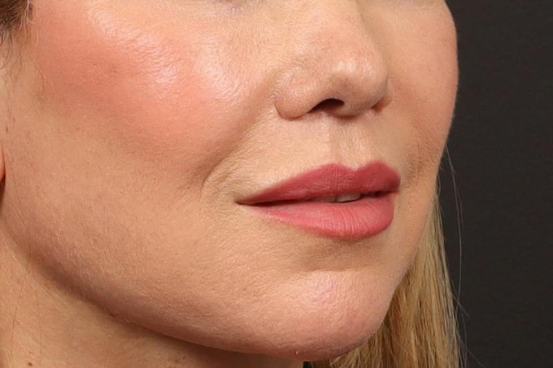 Lip Lift Before & After Gallery - Patient 418814 - Image 5