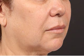 Lip Lift Before & After Gallery - Patient 418814 - Image 4