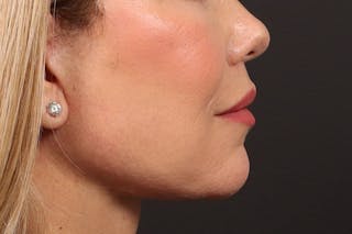 Lip Lift Before & After Gallery - Patient 418814 - Image 6