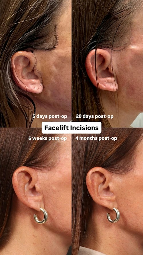Facelift Incisions