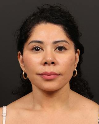 Facelift Before & After Gallery - Patient 226325 - Image 2