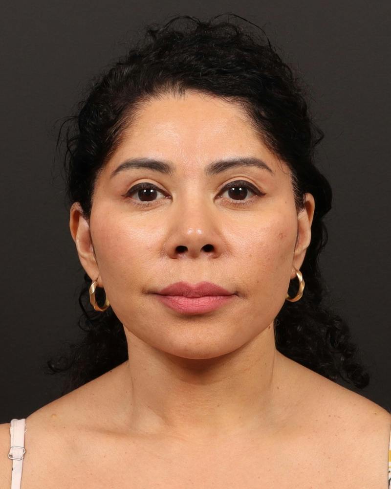 Facelift Before & After Gallery - Patient 226325 - Image 2