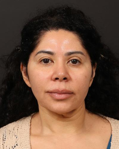 Facelift Before & After Gallery - Patient 226325 - Image 1
