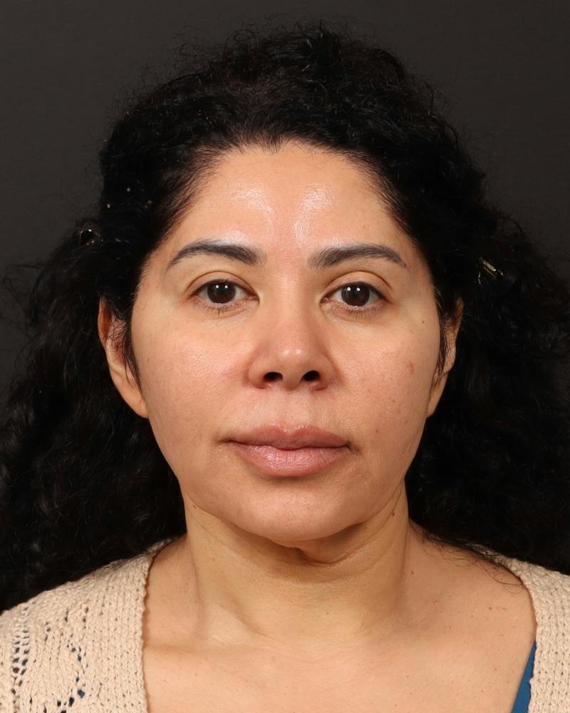 Facelift Before & After Gallery - Patient 226325 - Image 1