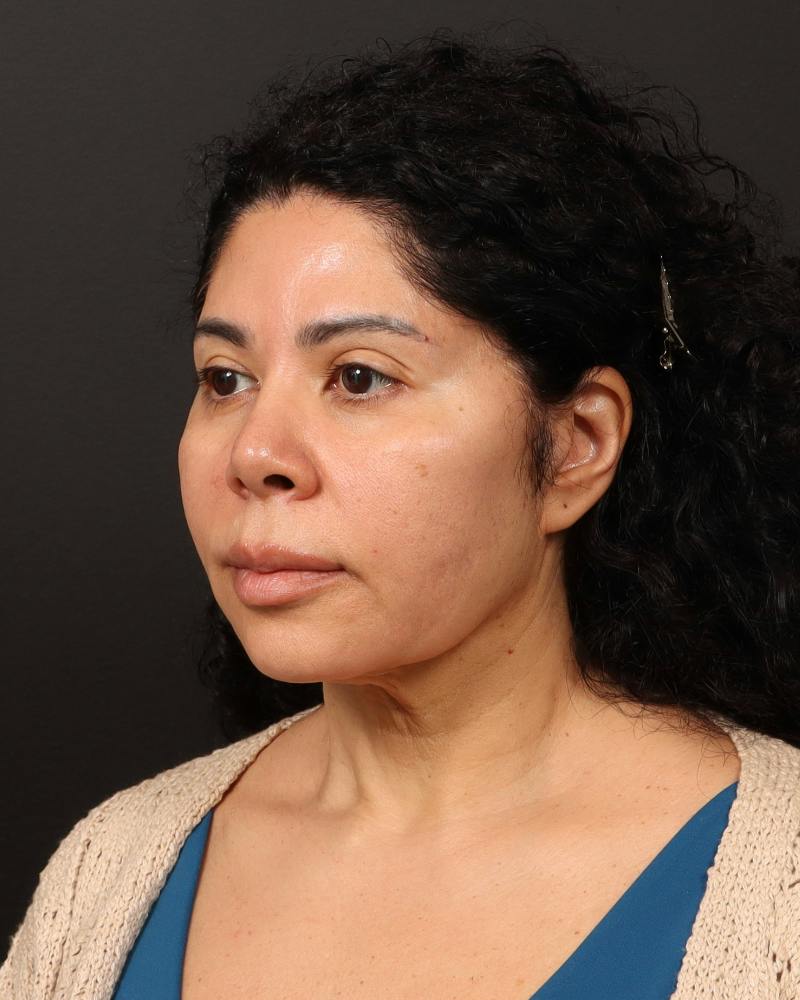 Facelift Before & After Gallery - Patient 226325 - Image 3