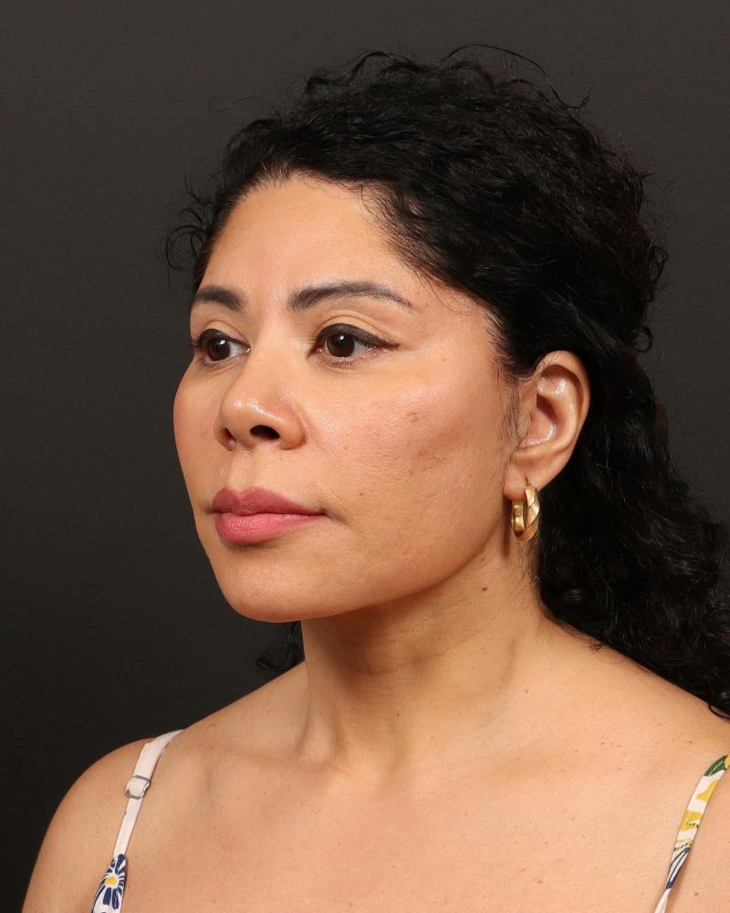 Facelift Before & After Gallery - Patient 226325 - Image 4