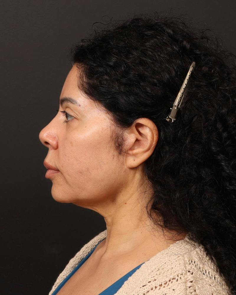 Facelift Before & After Gallery - Patient 226325 - Image 5