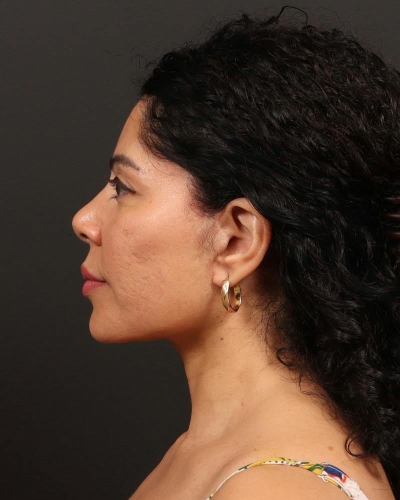 Facelift Before & After Gallery - Patient 226325 - Image 6