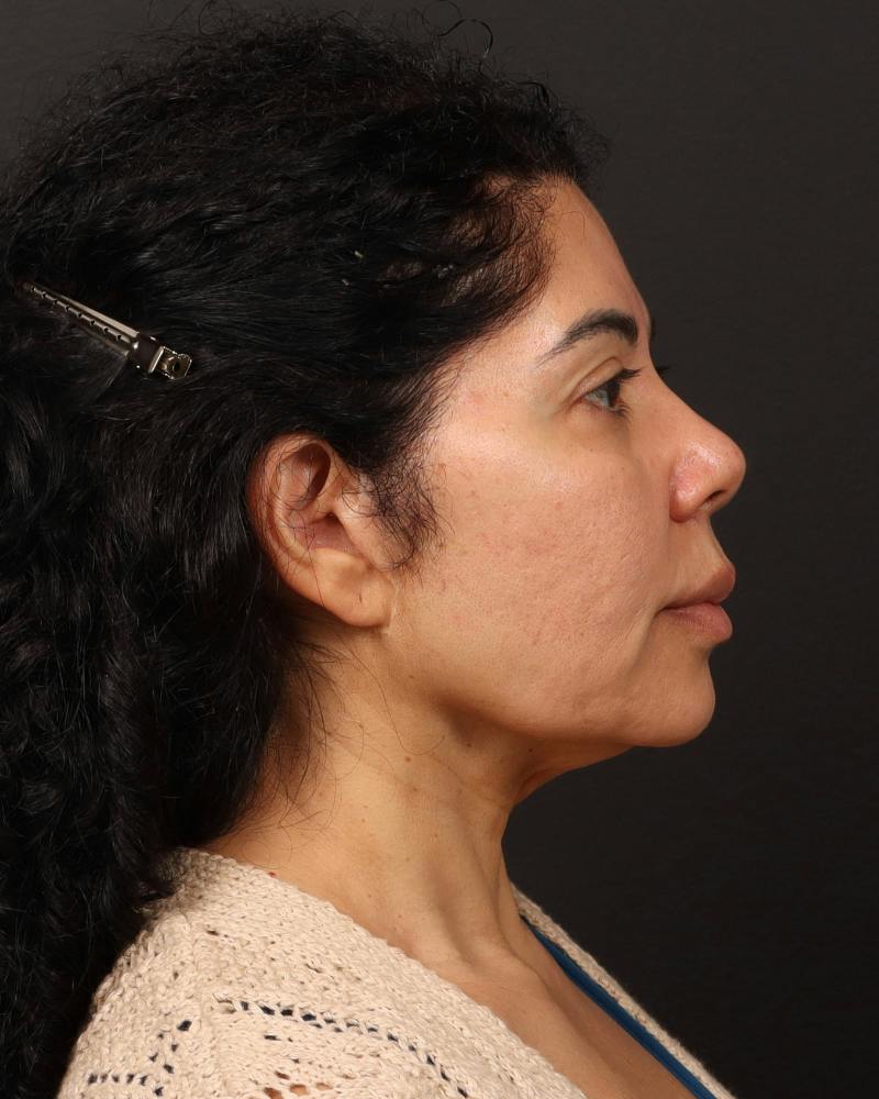 Facelift Before & After Gallery - Patient 226325 - Image 7