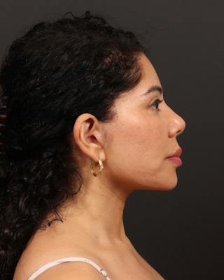 Facelift Before & After Gallery - Patient 226325 - Image 8