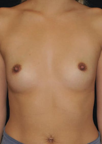 Breast Augmentation Before & After Gallery - Patient 792674 - Image 1