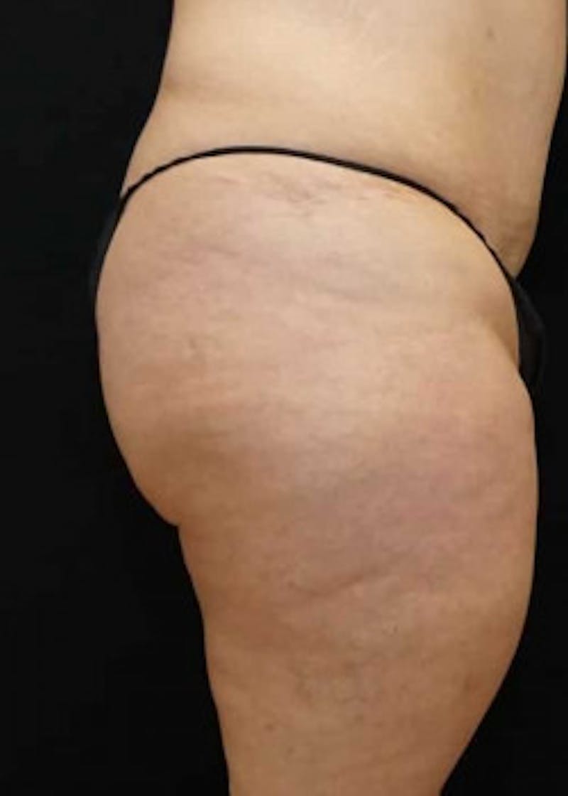 Brazilian Butt Lift Before & After Gallery - Patient 920336 - Image 1