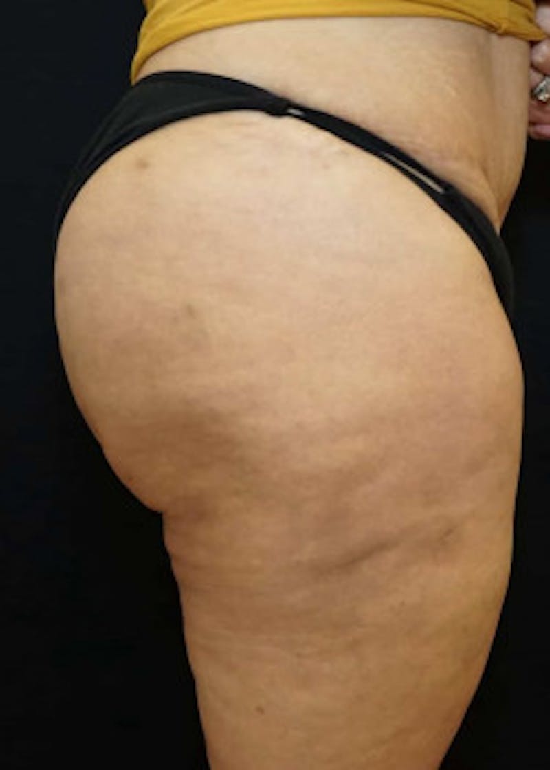 Brazilian Butt Lift Before & After Gallery - Patient 920336 - Image 2